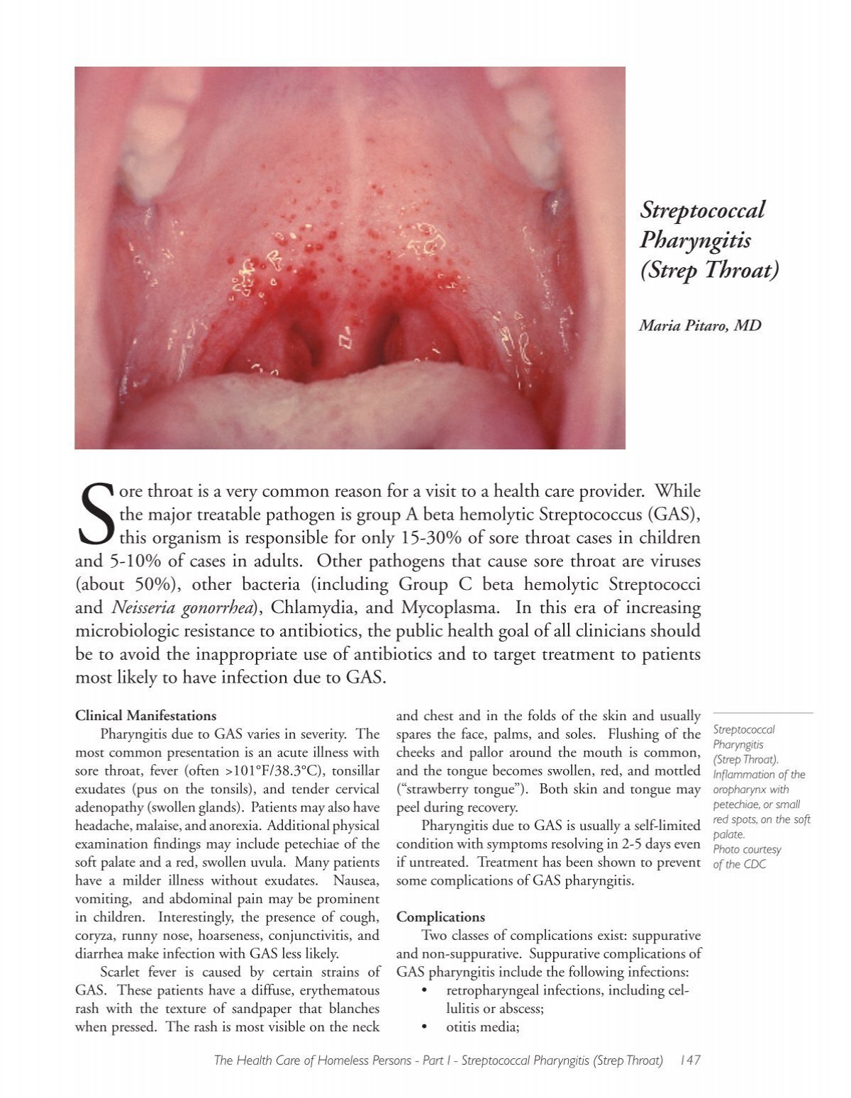 Streptococcal Pharyngitis Strep Throat Boston Health Care For The