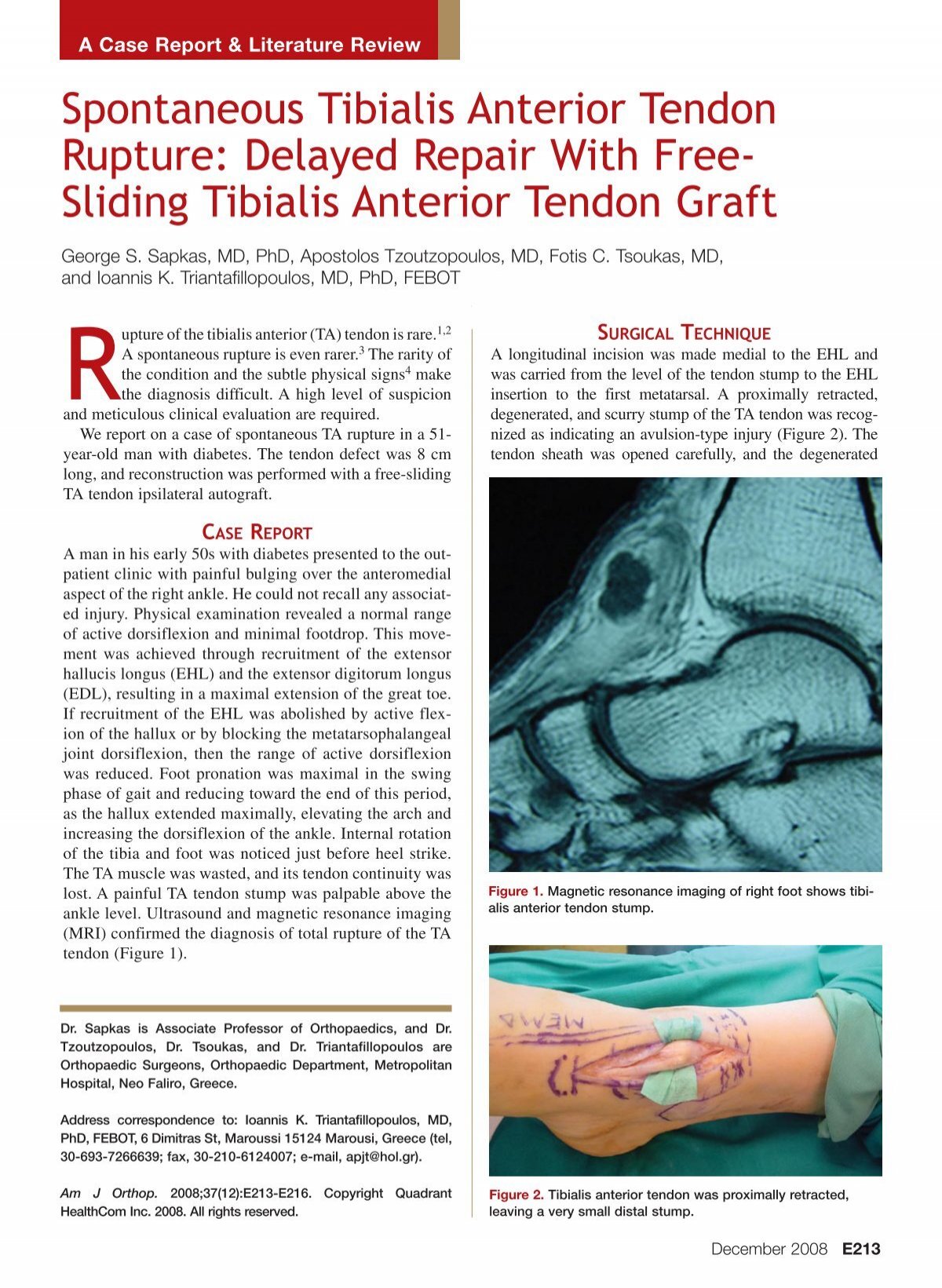 Spontaneous Tibialis Anterior Tendon Rupture Delayed Repair