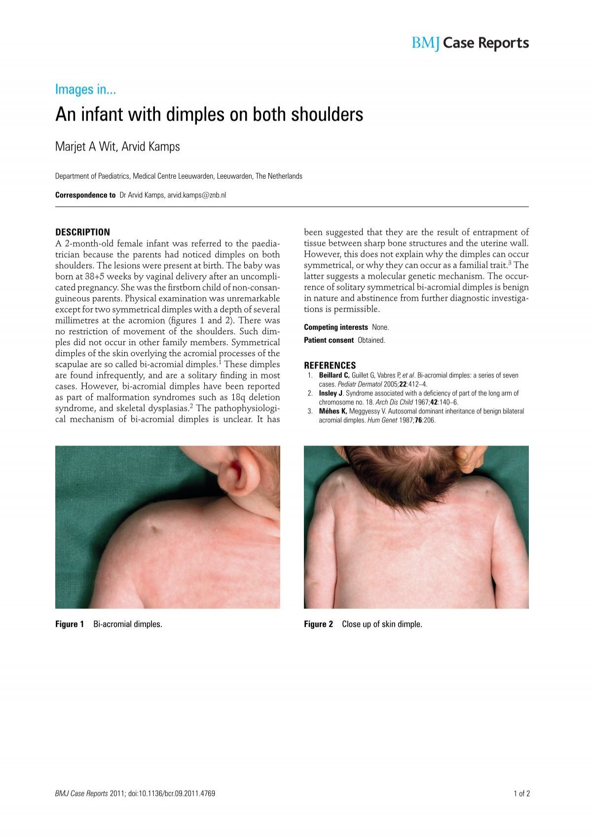 An Infant With Dimples On Both Shoulders Bmj Case Reports