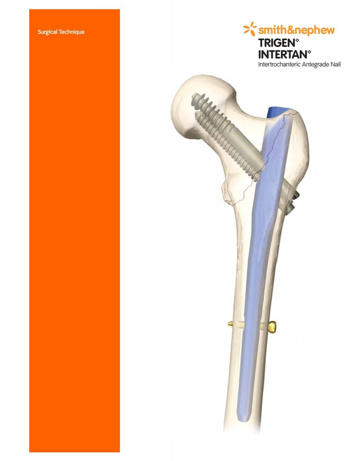 Intertan Femoral Interlocking Nail System Orthopedic Implants - China Femur  Intramedullary Nail System, Titanium | Made-in-China.com