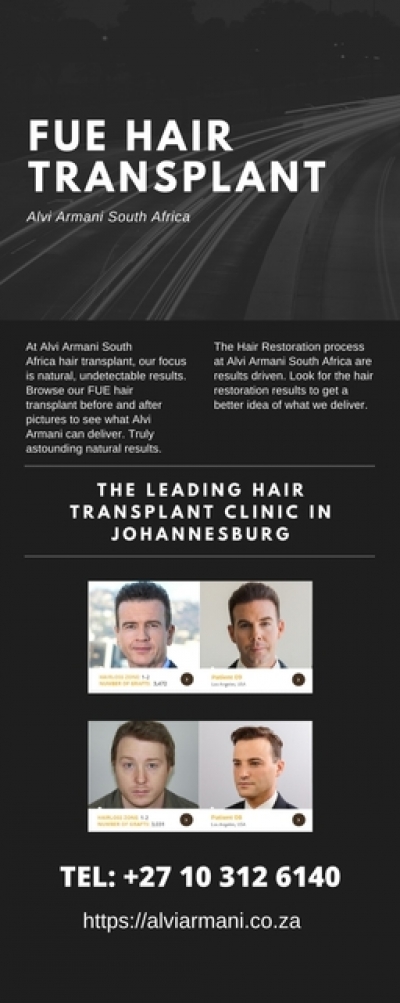 The Best FUE Hair Transplant in Johannesburg