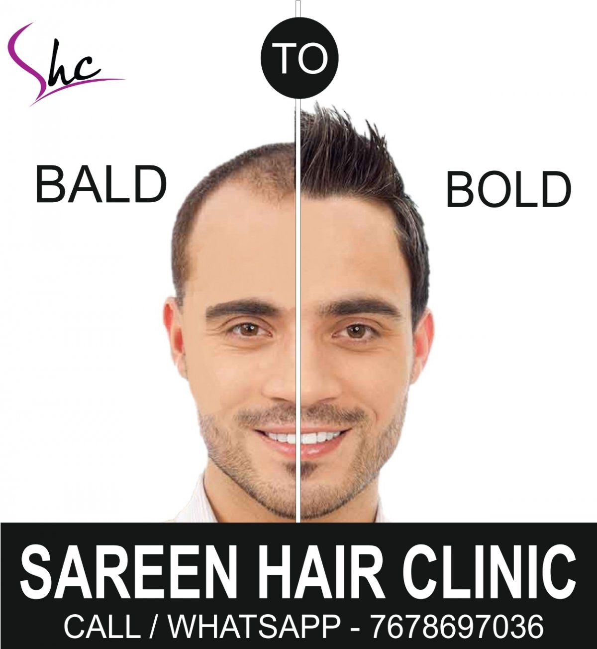 Tips For Taking Care of Your Hair After Hair Transplant by Sareen Hair  Clinic  Issuu