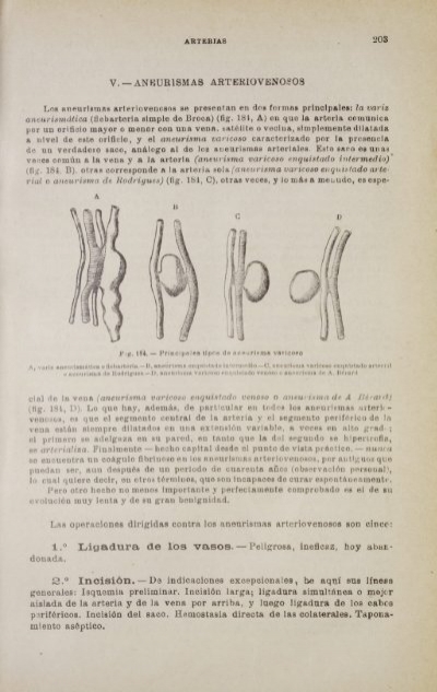 Amputarea piciorului în varicoză